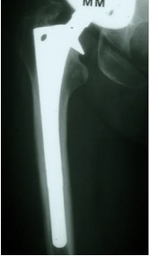 Femur Fully Coated Proximal Shielding